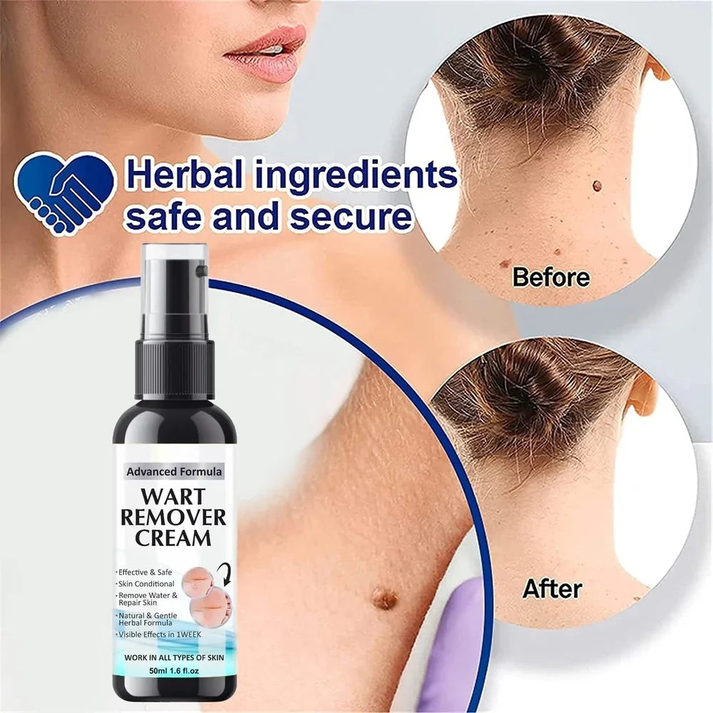 Wart Remover Cream - Pack of 2 Topical Treatment for Hands and Feet