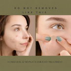 Acne Pimple Patch, Pack of 20