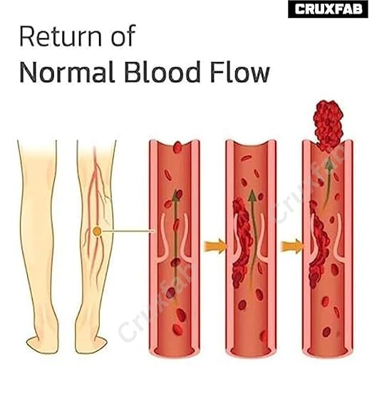 Varicose Veins Health Care Spray with Natural Herbal Formula